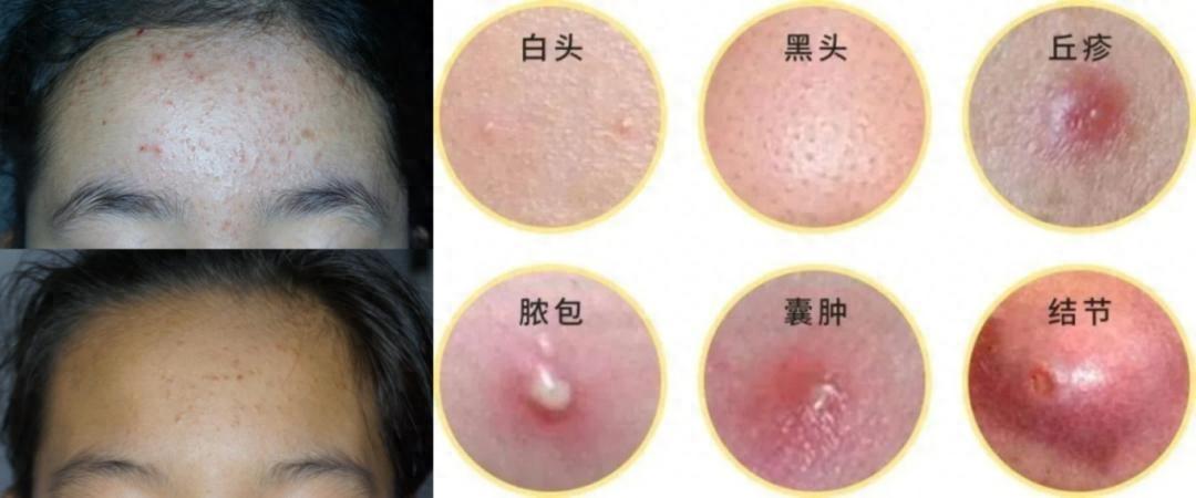 kiayun手机版登录app游戏登录入口.手机端安装.cc 当少男少女遇上“青春美丽痘”，怎么办？