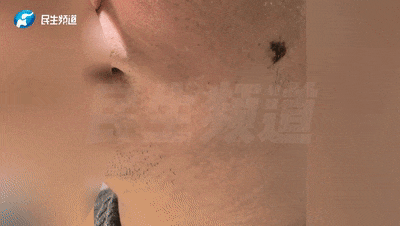 受伤后，男子意外发现脸上能吸住磁铁！医生都惊呼“从业20年第一次见”