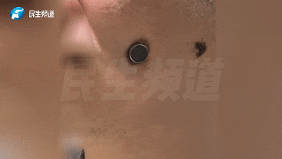 面部磁力吸铁石_颌面钢珠异物取出_生活中磁铁的应用视频