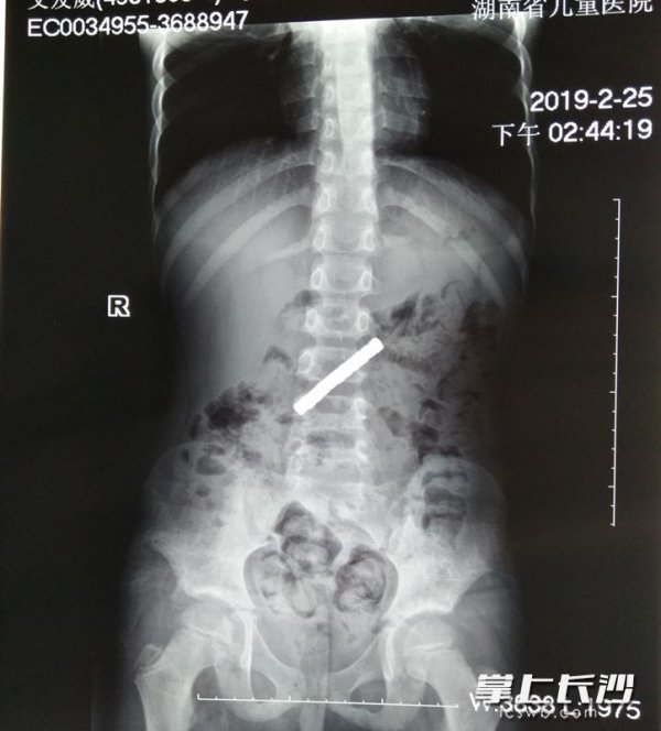 儿童吃磁铁 湖南省儿童医院 肠梗阻手术_生活中磁铁的应用视频
