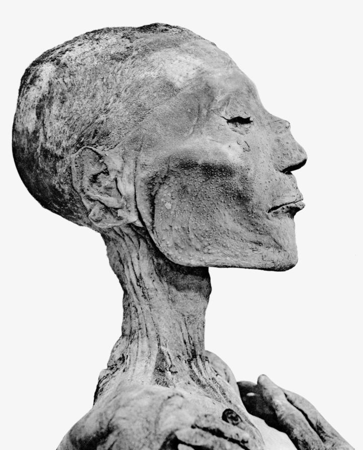 天花瘟疫历史_中国古代天花防治法_天花,痘病毒