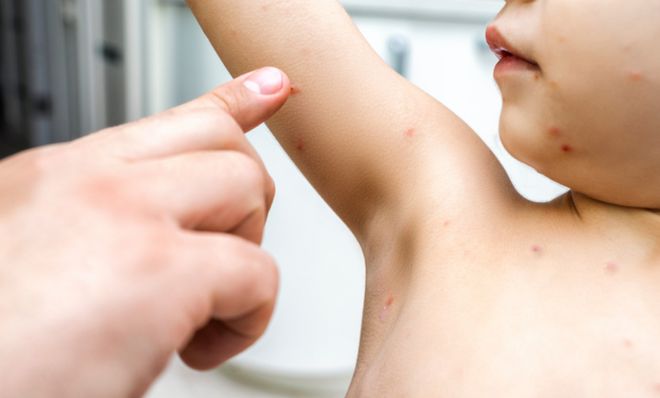 水痘病毒抗体_水痘病毒传播途径和症状_冬季儿童水痘预防