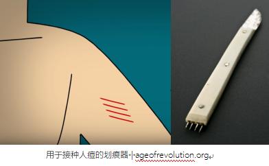 天花病毒 牛痘病毒_人痘接种法发展_天花病毒历史